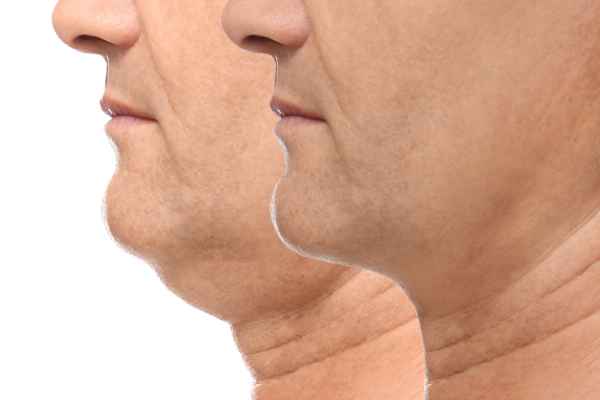 HIFU - Breakthrough in Anti - ageing 2 hifu results Greenock