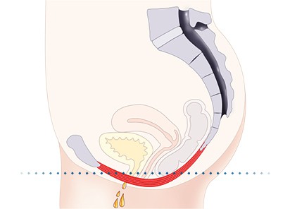 Pelvic-Floor Muscle Repair 5 Pelvic floor muscles Greenock