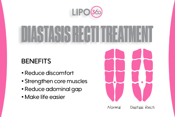 Revolutionising Muscle Repair: The Power of LIPO360 Body Sculpt Post-Injury 5 diastasis recti treatment Greenock