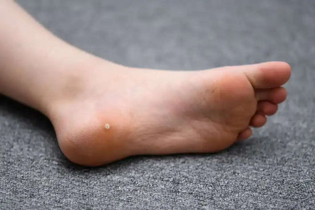 Cryotherapy For Warts And Also Verrucas 2 Image of verruca on the bottom of the foot that able to be treated with Cryotherapy Greenock