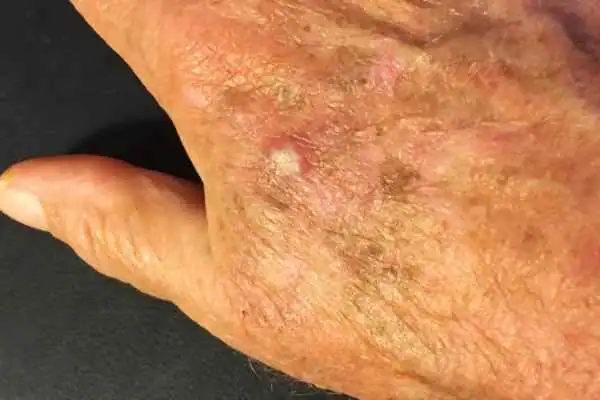 Image of Actinic keratoses Greenock  on a person hand