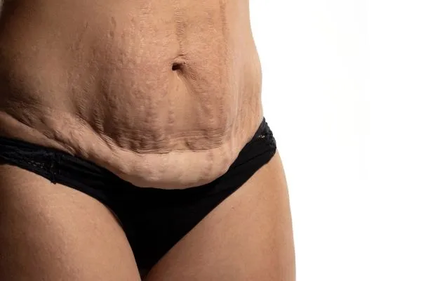 The Science of Skin Tightening 1 The science behind skin tightening Greenock picture of a woman's sagging skin on the stomach